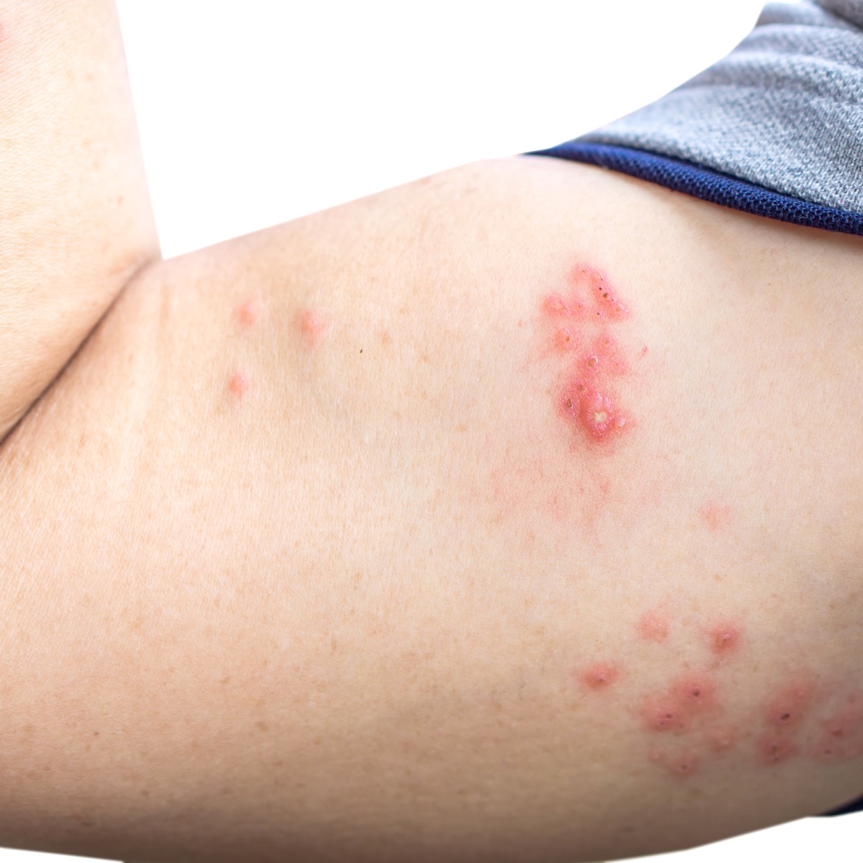  「帯状疱疹」は一度かかっても安心できない。知っておきたい初期症状や再発の可能性 