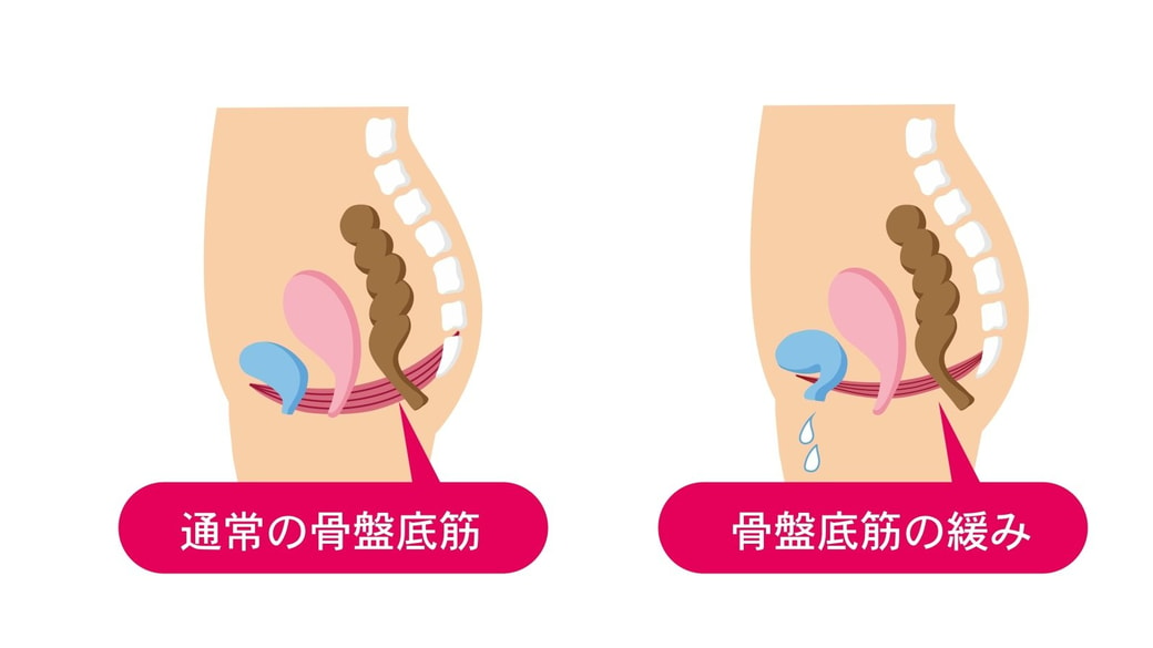 骨盤臓器脱の可能性