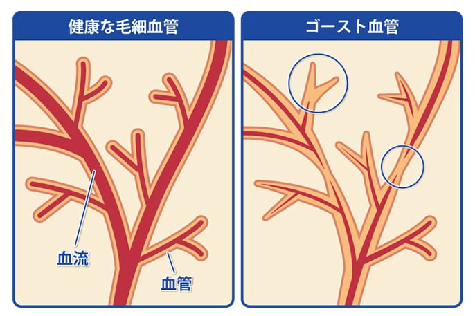 ゴースト血管