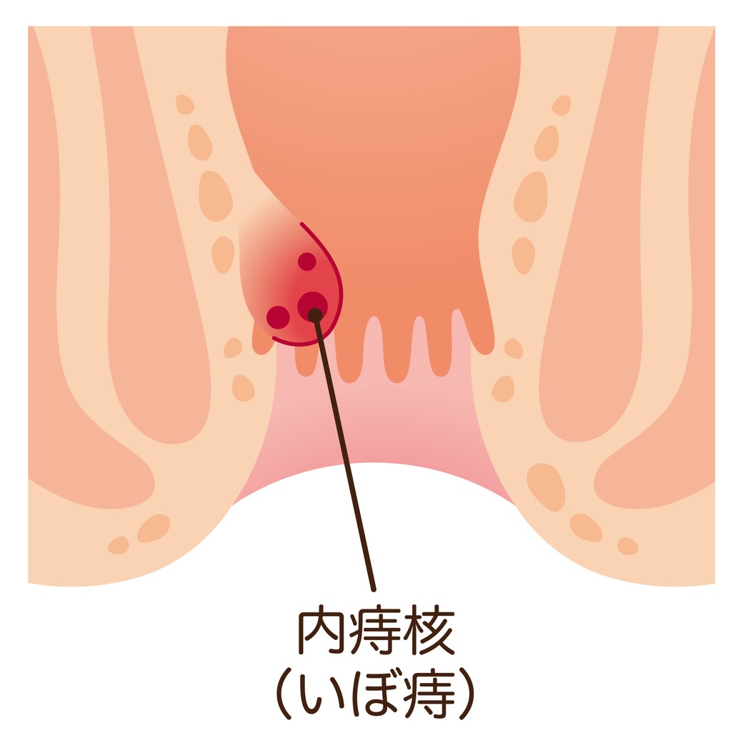 内痔核