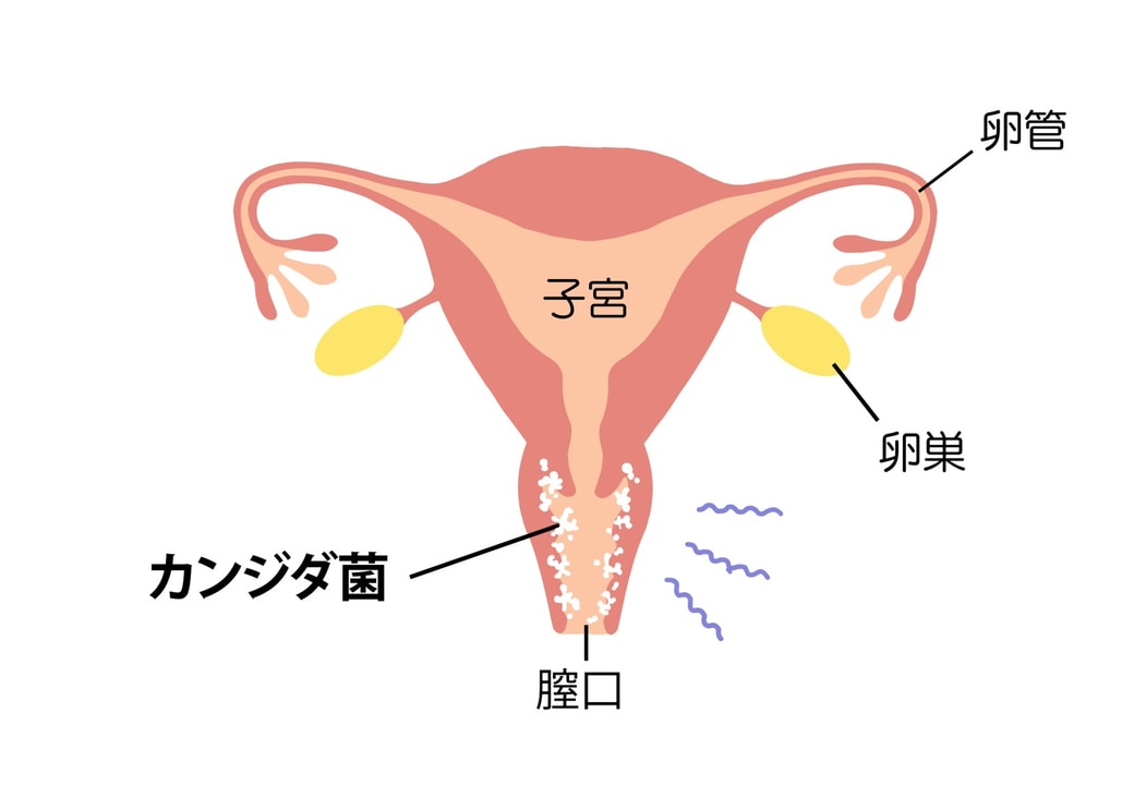 膣カンジダの主な症状