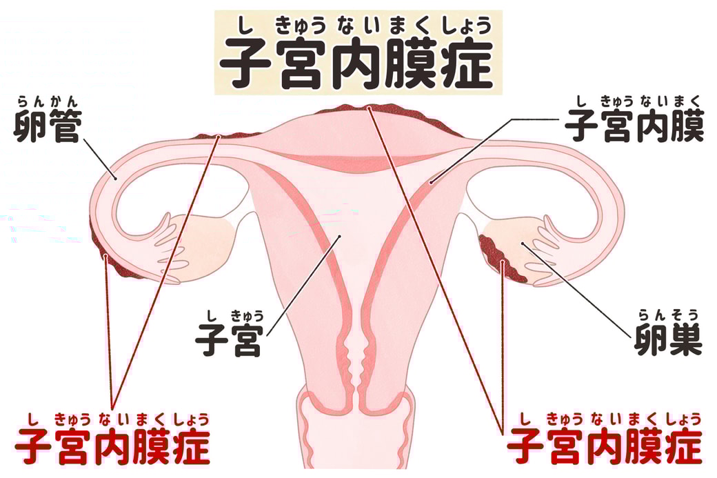 子宮内膜症